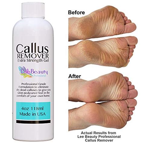 Say Hello to Summer-Ready Feet with Magic Callus Remover Gel